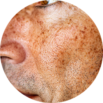 DARK SPOTS